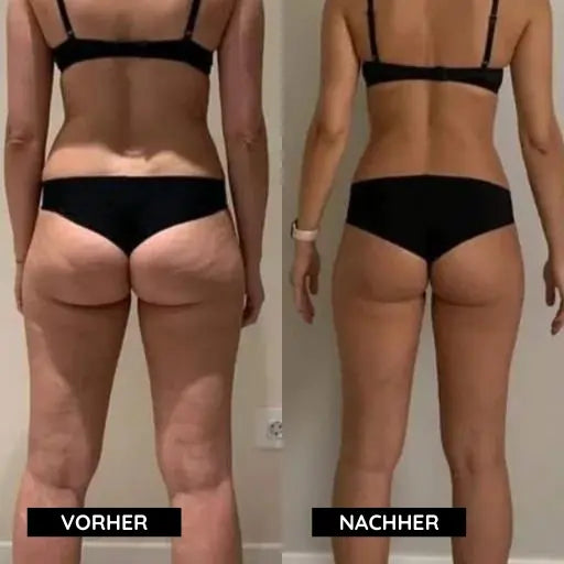Cellulite-Entferner Mivoza Deutschland