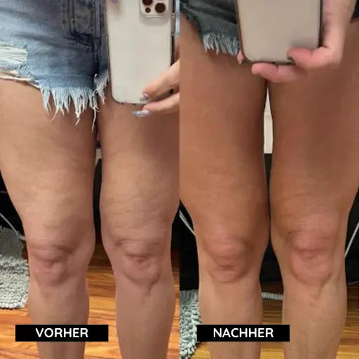 Cellulite-Entferner Mivoza Deutschland