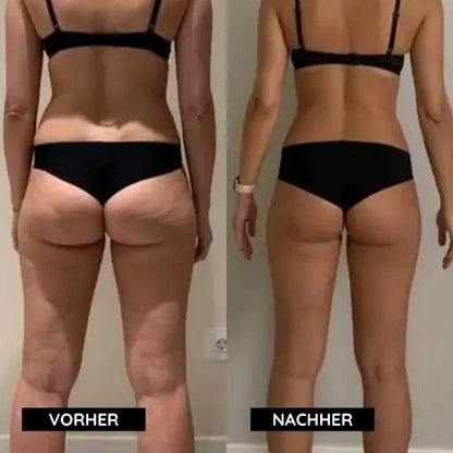 Cellulite-Entferner Mivoza Deutschland
