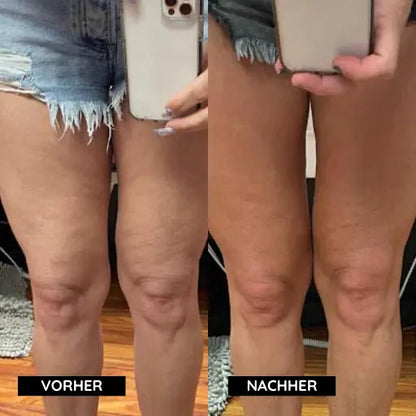 Cellulite-Entferner Mivoza Deutschland